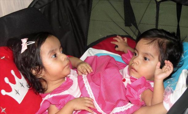 Fotografía de las niñas siamesas conocidas como 'Las Rositas', en Guatemala. EFE