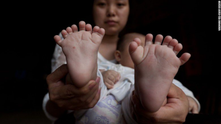 Un niño de casi cuatro meses nació con 31 dedos: 15 dedos en las manos y 16 dedos en los pies