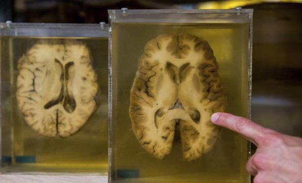 Vista de una parte del cerebro tras una disección. Archivo Efe