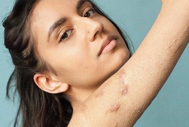 ESPAÑA, 2018. La fotógrafa Sophie Mayanne ha hecho de las cicatrices las protagonistas de sus obras. Instagram @behindthescars_ y @sophiemayanne. Efe