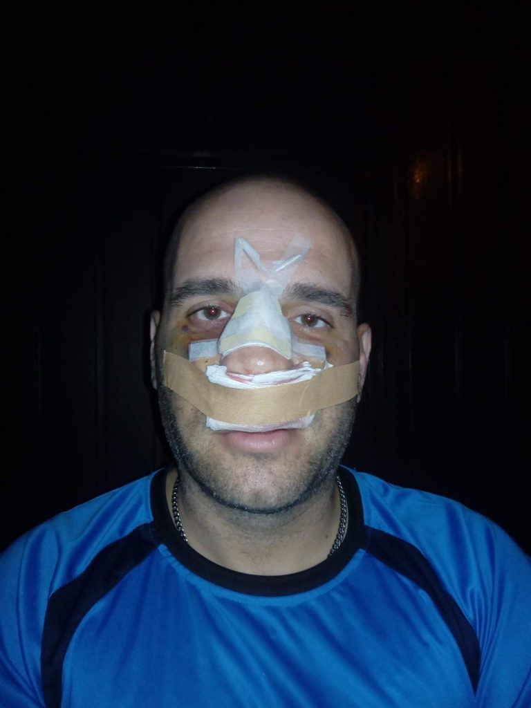 Operado el Policía Nacional linchado por centenares de independentistas el 29-S