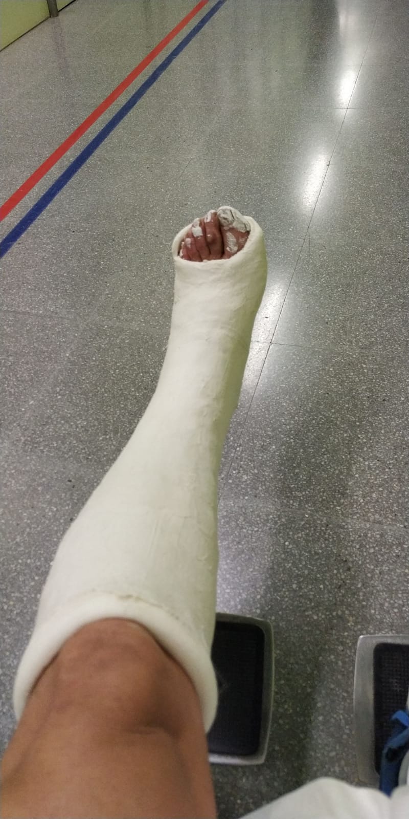 MATARÓ (BARCELONA), 18.12.2018. Vista de la pierna izquierda del español perseguido en Cataluña. Agresión Cake Minues. Ñ Pueblo (1)