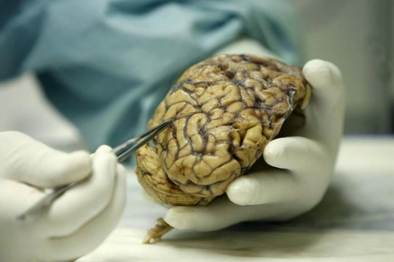 La proteína «TREM2» retrasa la progresión del Alzheimer