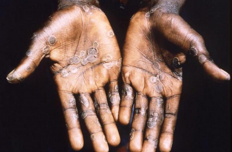 FOTOGRAFÍA. ÁFRICA, MAYO DE 2022. ¿Qué es el Monkey Pox (MPox) o Viruela del Mono?.- Las autoridades portuguesas han notificado 49 casos de viruela del mono o monkeypox este miércoles, 10 más que los registrados el día anterior, todos de sexo masculino y la mayoría en Lisboa, mientras esperan los resultados de otras muestras. Efe