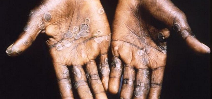 FOTOGRAFÍA. ÁFRICA, MAYO DE 2022. ¿Qué es el Monkey Pox (MPox) o Viruela del Mono?.- Las autoridades portuguesas han notificado 49 casos de viruela del mono o monkeypox este miércoles, 10 más que los registrados el día anterior, todos de sexo masculino y la mayoría en Lisboa, mientras esperan los resultados de otras muestras. Efe