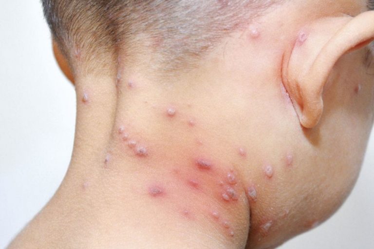 FOTOGRAFÍA. MUNDO, MAYO DE 2022. Las autoridades portuguesas han notificado 49 casos de viruela del mono o monkeypox este miércoles, 10 más que los registrados el día anterior, todos de sexo masculino y la mayoría en Lisboa, mientras esperan los resultados de otras muestras. línea directa portal / Lasvocesdelpueblo (Ñ Pueblo). Lasvocesdelpueblo (Ñ Pueblo)