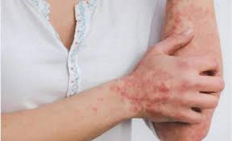 Viruela del mono| España confirma 59 casos positivos de «viruela no humana»