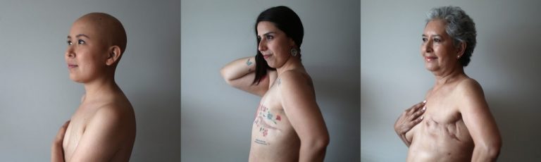 Cáncer de mama en 3 generaciones| Sandra, Lorena y María Ángeles son pacientes oncológicas que pasaron por mastectomía sin reconstrucción