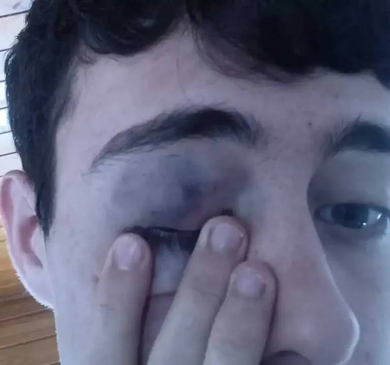 FOTOGRAFÍA. CATALUÑA (REINO DE ESPAÑA), 13 DE MAYO DE 2025. En la imagen, el portavoz de la asociación patriota española "Make España Great Again (MEGA)", Abel Trujillo, "brutalmente atacado por un grupo de encapuchados", informan fuentes de MEGA en un comunicado este martes. Lasvocesdelpueblo (Ñ Pueblo)