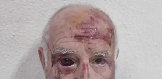 FOTOGRAFÍA. TORRE-PACGECO (REGIÓN DE MURCIA) REINO DE ESPAÑA, 09 DE JULIO DE 2025. El anciano español don Domingo ha sobrevivido de una paliza brutal propinada por parte de sus verdugos inmigrantes magrebíes, concretamente "marroquíes", en las inmediaciones del cementerio municipio y ciudad española de la Comunidad Autónoma de Murcia, Torre-Pacheco, a las 5:45 horas de la mañana de este miércoles 9 de julio de 2025 y aunque tardará meses para recuperar el color de sus ojos aún llenos de sangre coagulada, puede seguir viviendo para contar su calvario en manos de los "Bienvenidos" de las políticas de "Fronteras Abiertas" del partido Popular (PP) y Partido Socialista (PSOE) con la gran estafa de que inmigrantes ilegales "vienen a pagar la pensión" a don Domingo. Pues, así como ha quedado la víctima, lo que no dice el PP y PSOE es que los inmigrantes islamistas "vienen a" matar a don Domingo y al resto de la gente anciana de nuestro país. Lasvocesdelpueblo (Ñ Pueblo)