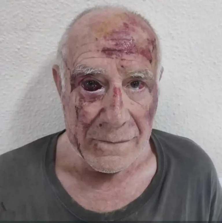 FOTOGRAFÍA. TORRE-PACGECO (REGIÓN DE MURCIA) REINO DE ESPAÑA, 09 DE JULIO DE 2025. El anciano español don Domingo ha sobrevivido de una paliza brutal propinada por parte de sus verdugos inmigrantes magrebíes, concretamente "marroquíes", en las inmediaciones del cementerio municipio y ciudad española de la Comunidad Autónoma de Murcia, Torre-Pacheco, a las 5:45 horas de la mañana de este miércoles 9 de julio de 2025 y aunque tardará meses para recuperar el color de sus ojos aún llenos de sangre coagulada, puede seguir viviendo para contar su calvario en manos de los "Bienvenidos" de las políticas de "Fronteras Abiertas" del partido Popular (PP) y Partido Socialista (PSOE) con la gran estafa de que inmigrantes ilegales "vienen a pagar la pensión" a don Domingo. Pues, así como ha quedado la víctima, lo que no dice el PP y PSOE es que los inmigrantes islamistas "vienen a" matar a don Domingo y al resto de la gente anciana de nuestro país. Lasvocesdelpueblo (Ñ Pueblo)