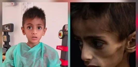 FOTOGRAFÍA. ITALIA, 28 DE JULIO DE 2025, Y GAZA, UN MES ANTES 25 DE JUNIO DE 2025. No es hambre: el niño gazatí Osama padecía grave enfermedad. En la izquierda y en la derecha de la imagen, el mismo niño gazatí de cinco años, Osama al-Rakab. Hace un mes, Israel registró al niño Osama al-Rakab como paciente de una grave enfermedad rara y el COGAT israelí tramitó su salida de gaza por el Aeropuerto Internacional Ramon rumbo a Italia junto a su mamá y hermano. Un mes después, Israel tuvo razón y el paciente, en la izquierda, se va recuperando poco a poco mientras la mentira de la hambruna en Gaza se desmorona. ¿Si era por la hambre por qué su hermano y su madre estaban y siguen estando sanos? Lasvocesdelpueblo (Ñ Pueblo)